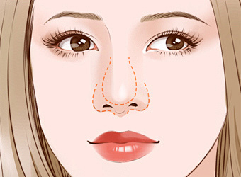 拉萨做耳软骨垫鼻尖费用明细，术后留疤吗