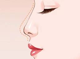 维多医生告诉你:注射隆鼻必知的小常识有哪些?